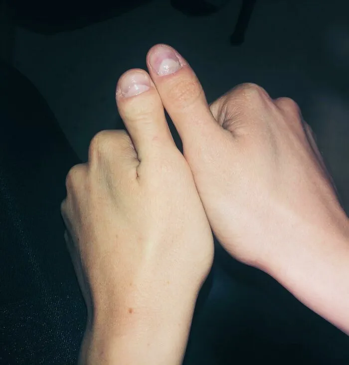 I Have Fraternal Thumbs, 1 From Each Parent Due To A Genetic Mutation On My Dads Side (Unilateral Brachydactyly Type D)