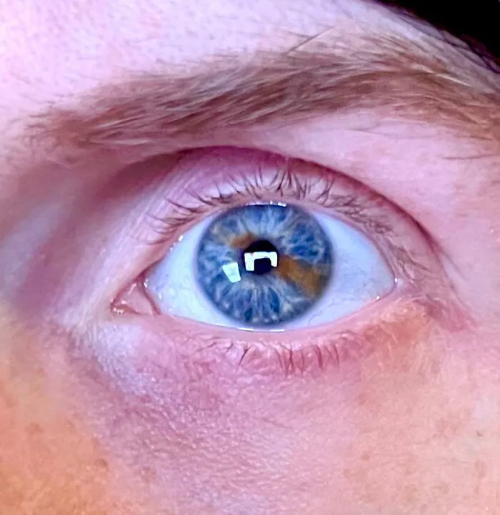 My Left Eye Has Two Colors: