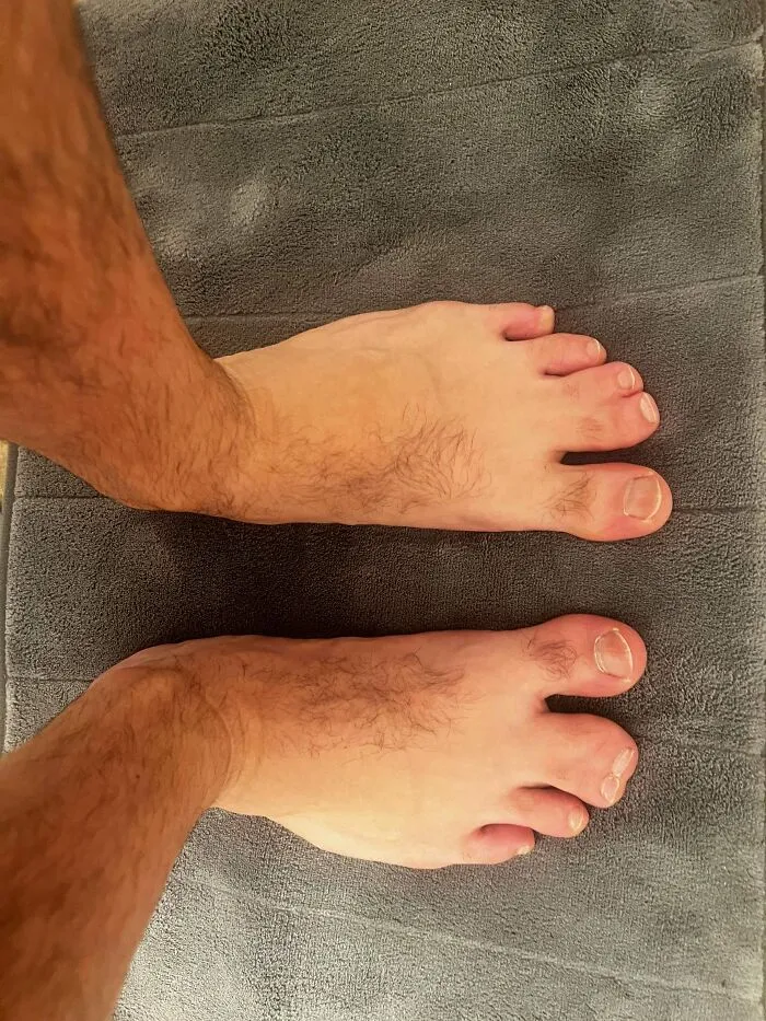 Webbed Toes - After 40 Years Of Hiding These… Ive Decided To Reveal!