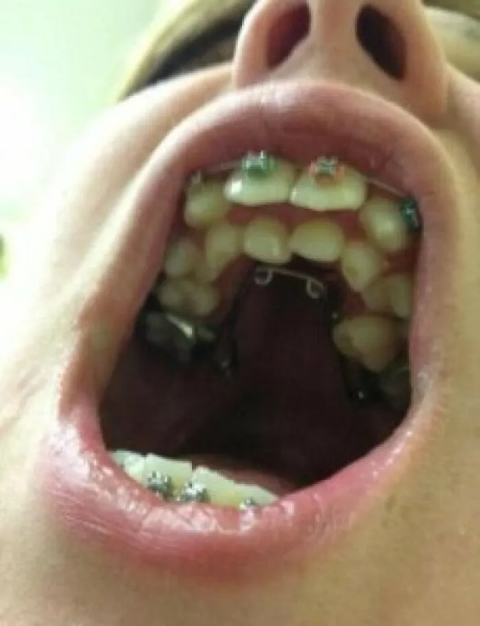 This Is A Condition Called Hyperdontia