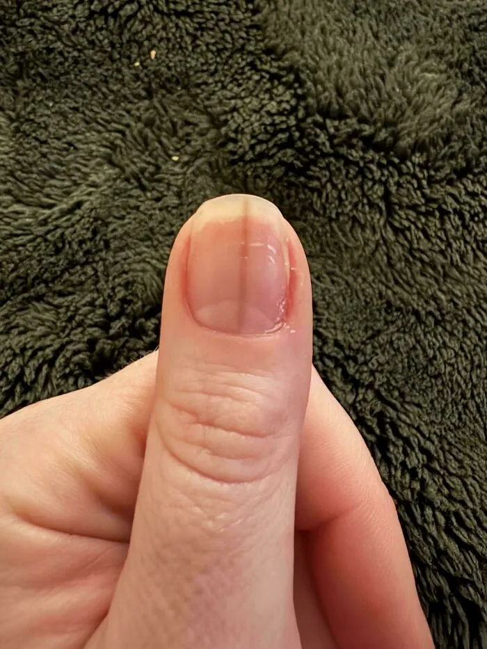 Dark Tan Line Showed Up On My Thumb Nail, Won’t Go Away