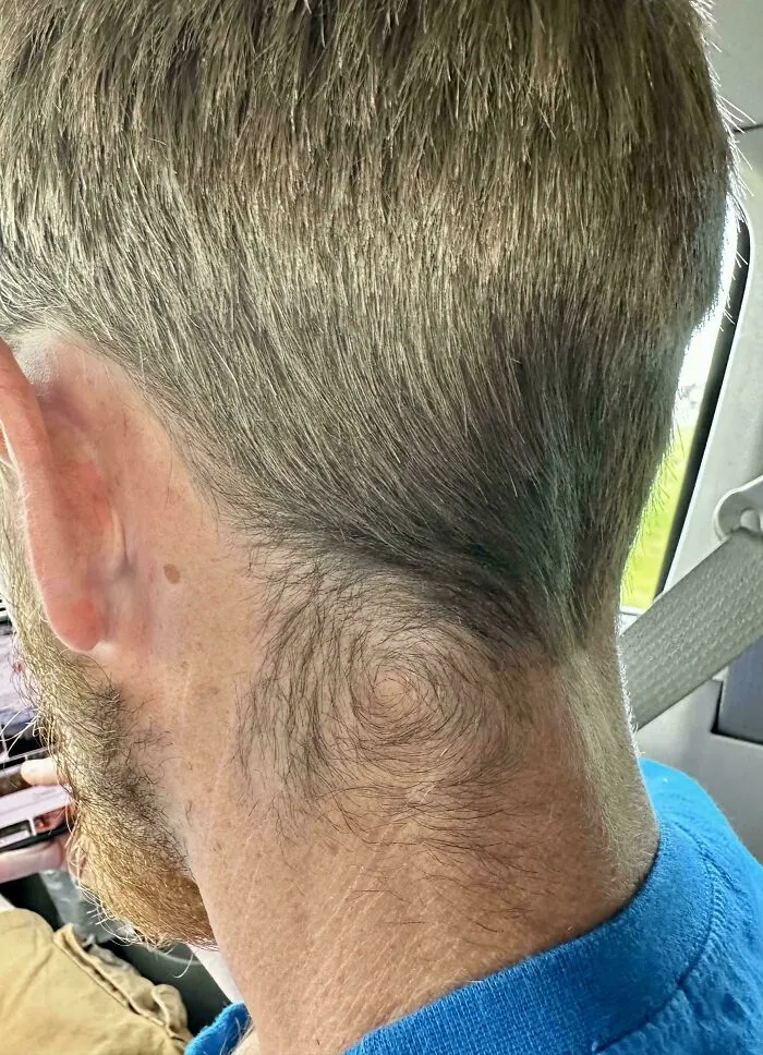 Mi novio tiene estos remolinos en ambos lados del cuello