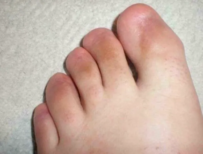 Feet With No Toe Nails