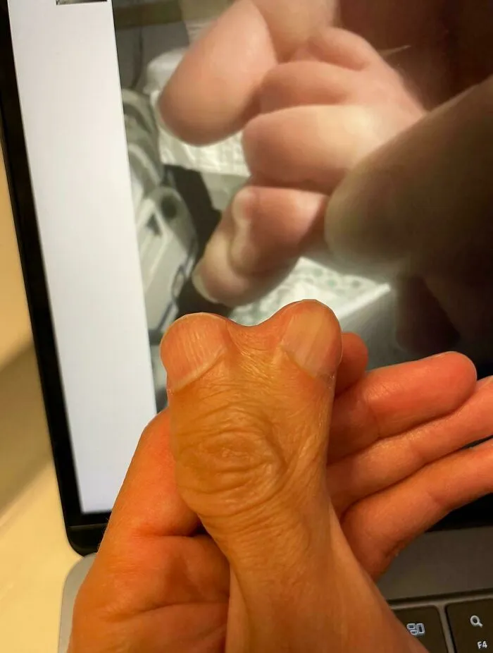 Nunca había visto una foto de un recién nacido con el pulgar en forma de corazón. ¡Bienvenido al club del pulgar corazón, pequeñín!