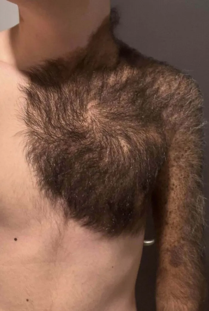 I Was Born With A Giant Congenital Nevus