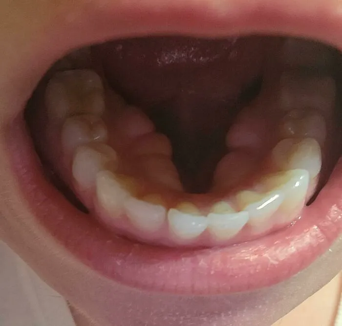 Rare physical feature of underbite teeth in mouth close-up