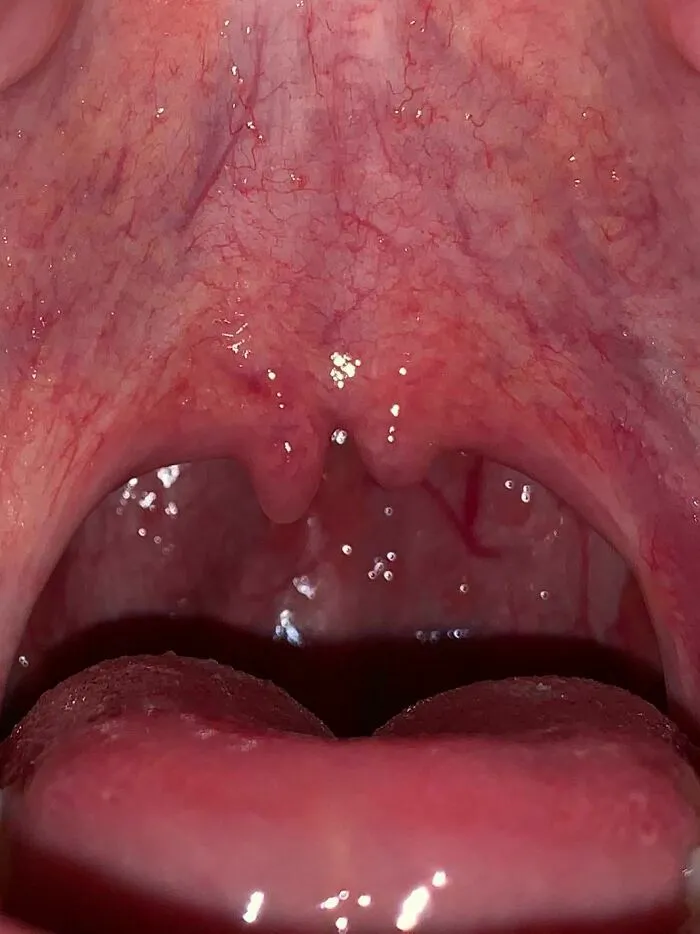 Throat with rare uvula split visible inside mouth