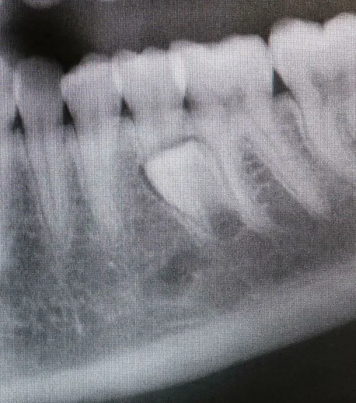 Dental X-ray showing rare tooth anomaly and jawbone structure