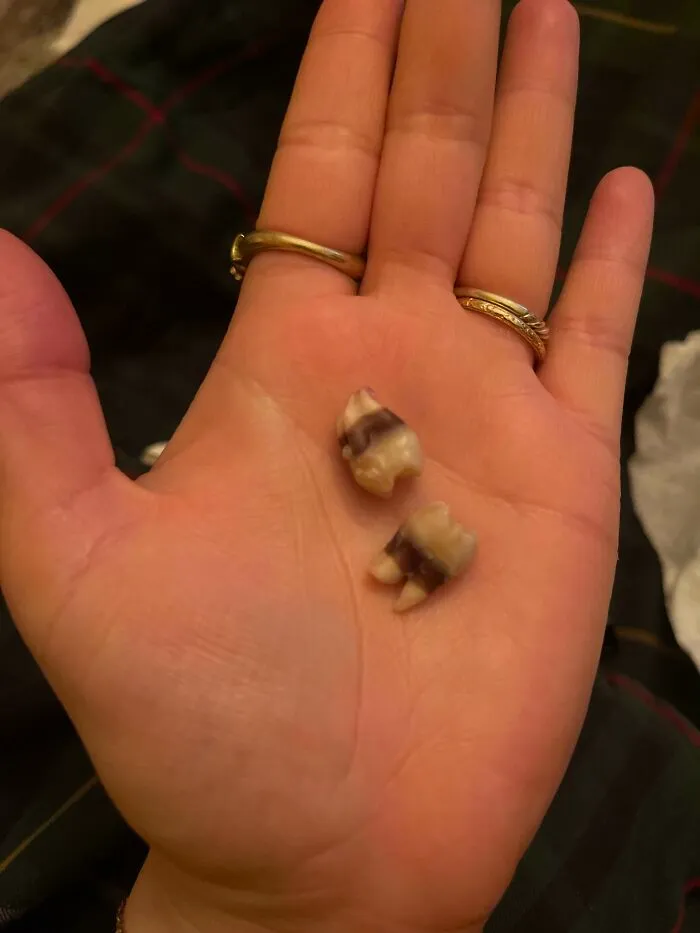 Hand holding two extracted teeth with unusual coloring and shape