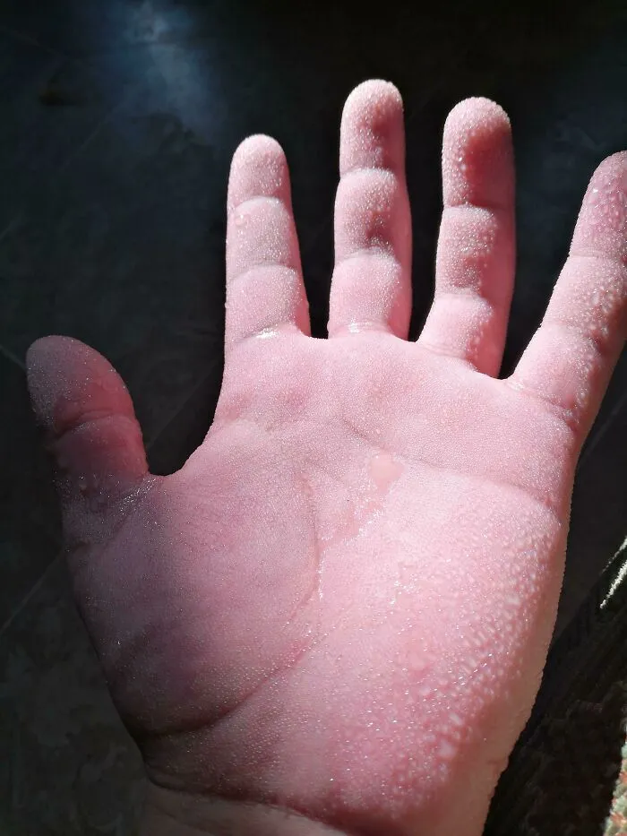 Hand with unusual grainy skin texture highlighting rare physical features
