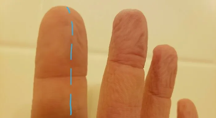 Unique finger shape with a straight blue line highlighting rare physical features
