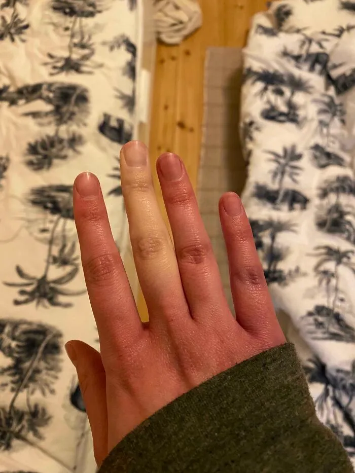 Hand exhibiting rare skin pigmentation with one pale finger