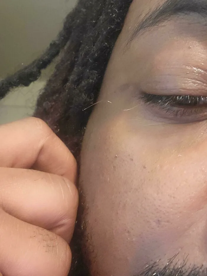 Close-up of rare facial hair pattern on cheek