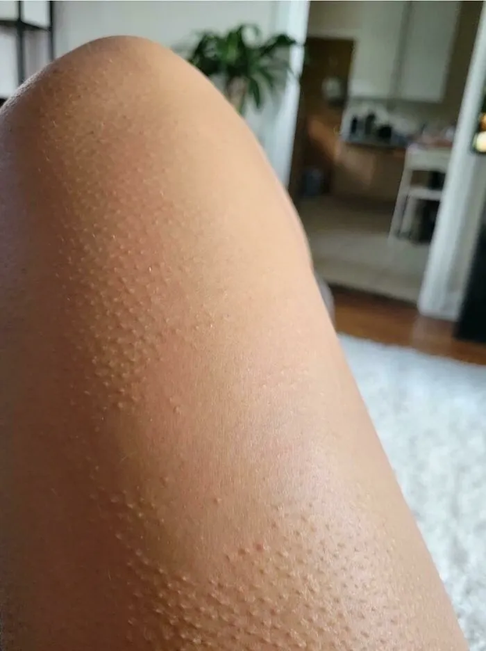 Skin with goosebumps showing rare physical features on arm
