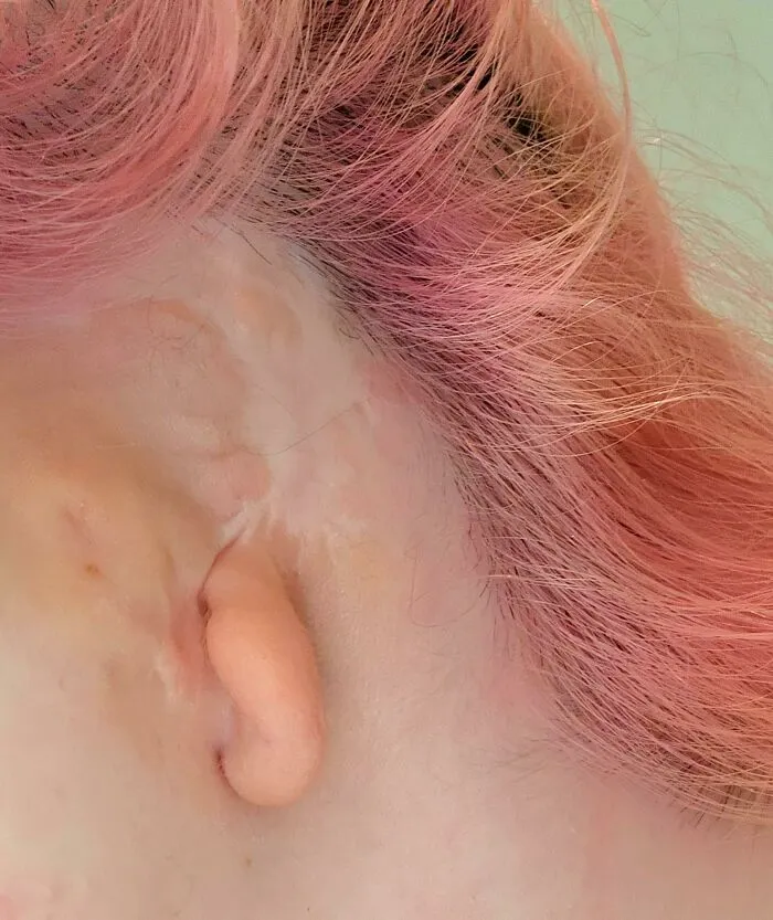 Close-up of rare physical ear deformity with pink hair