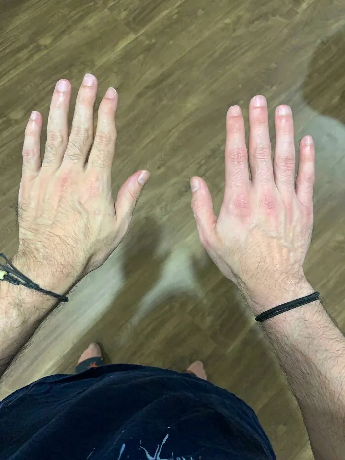 Unique physical features shown by hands with irregular veins and skin tone