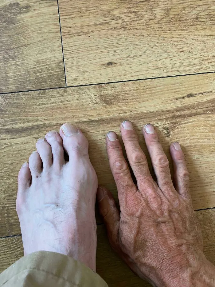 Rare physical features with mismatched foot and hand on wooden floor