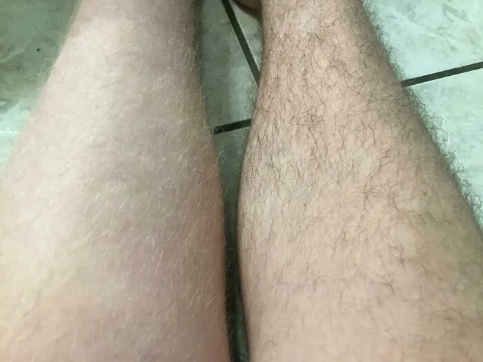 Legs with stark contrast in hair density illustrating rare physical feature