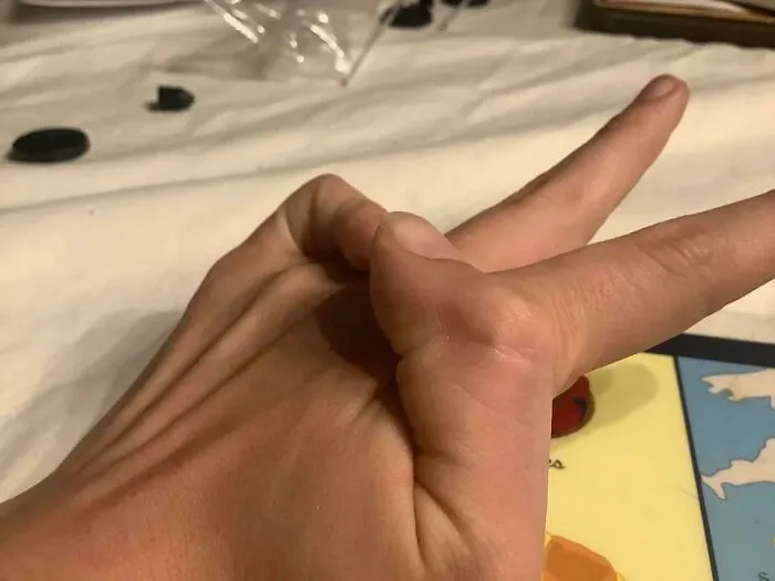 Hand demonstrating a rare hyperflexible finger bending backward