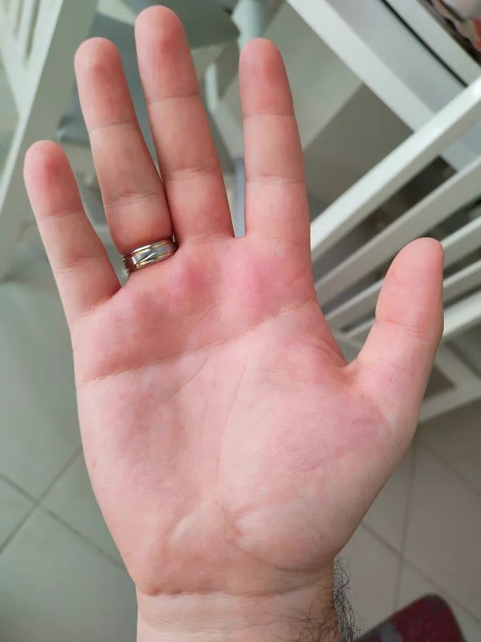 Hand with six fingers showing rare physical feature