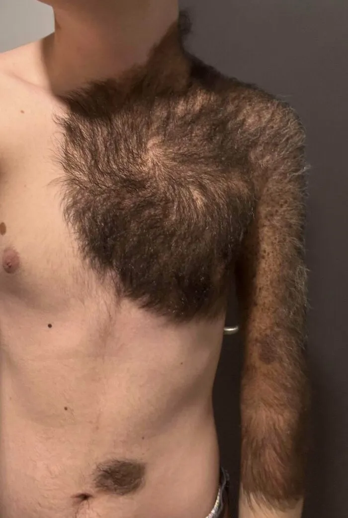 Person with extremely hairy chest and arm showing rare physical features