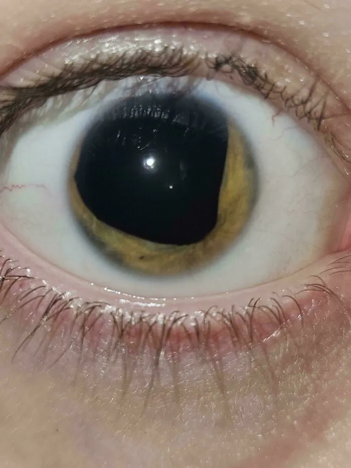 Extreme close-up of dilated pupil in eye showing rare physical feature
