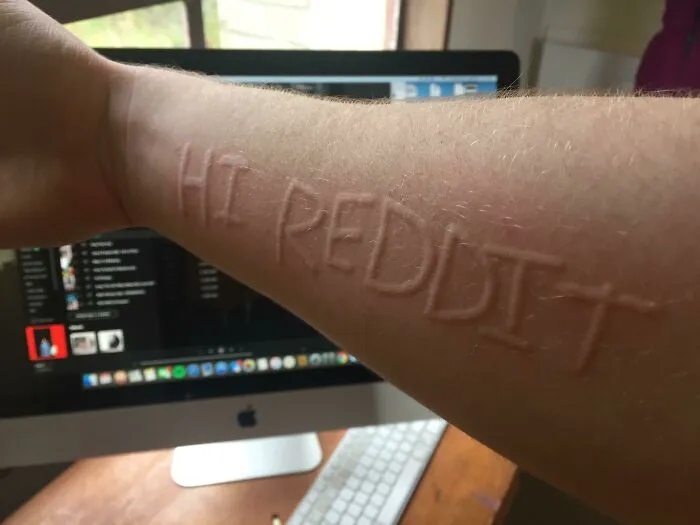Forearm with embossed scar text reading HI REDDIT showing rare physical feature