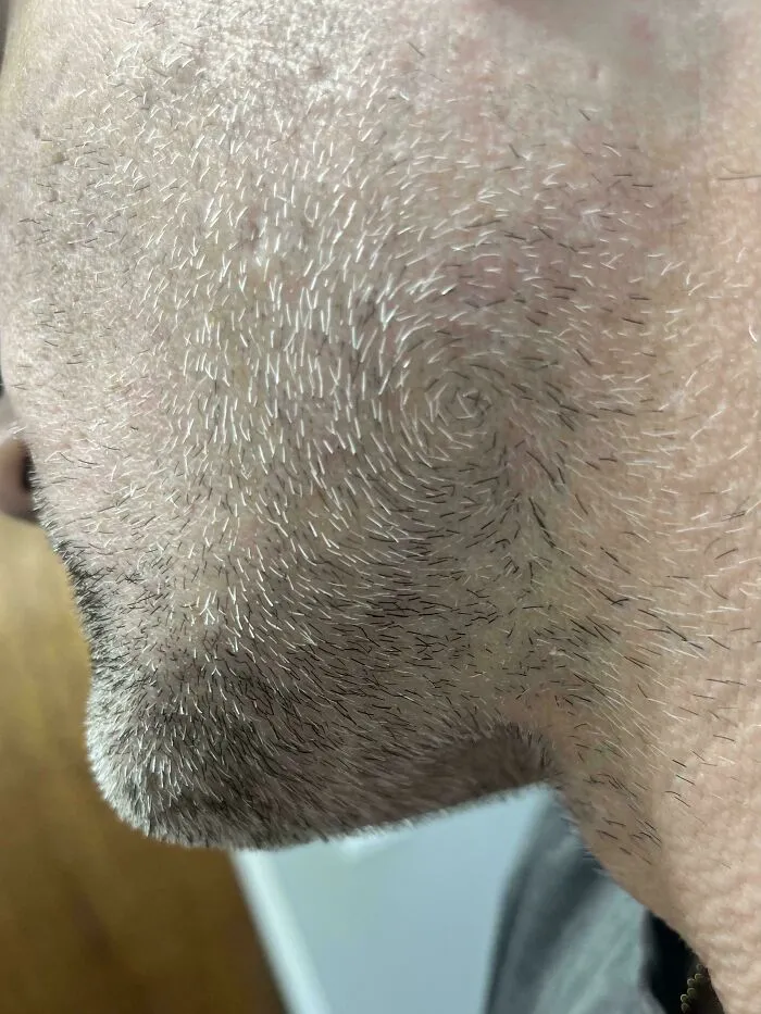 Rare hair growth pattern on person's chin showing white and black hair follicles