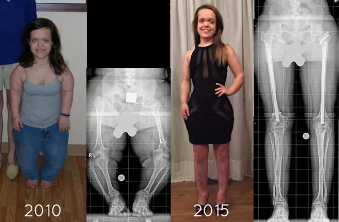 A Patient With Achondroplasia (Dwarfism) Before & After One Arm Lengthening And Two Leg Lengthening Treatments. She Started At Her Mature Height Of 3’10” And Now Is 4’11, And She Gained 4 Inches Of Arm Length
