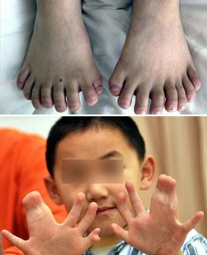 Child showing hands and feet with rare physical deformities
