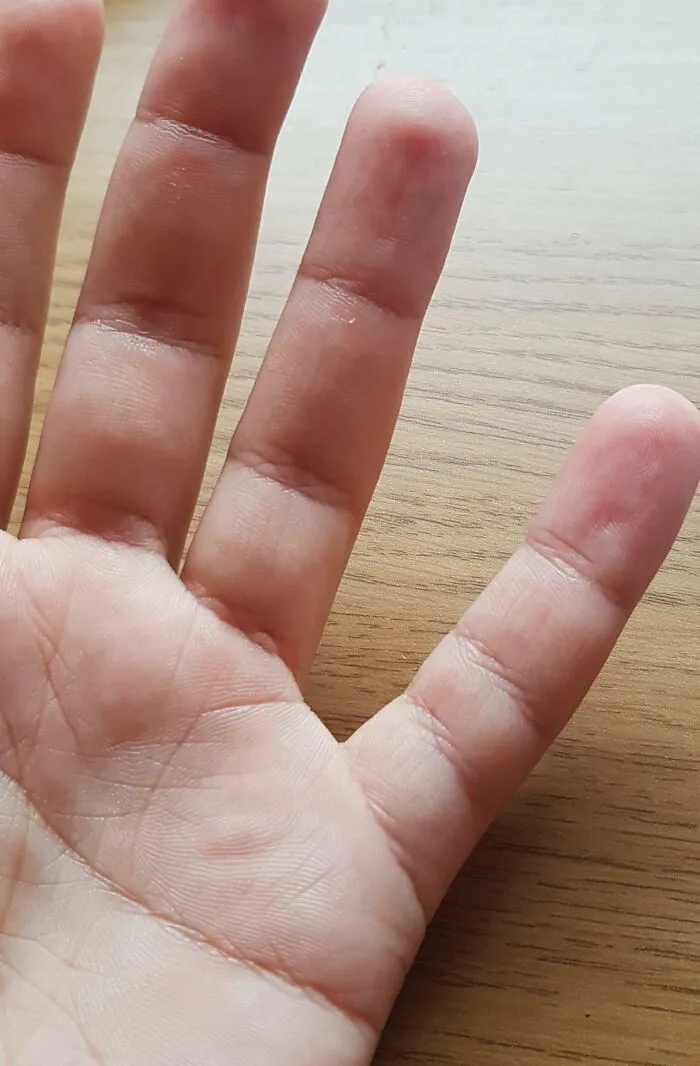 Hand with fingers showing unusual smooth skin texture