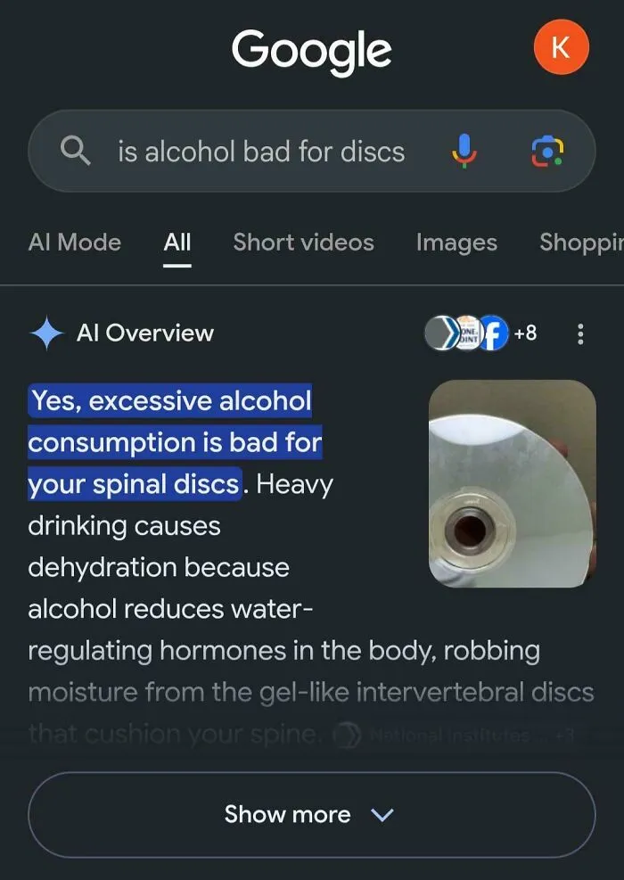 Screenshot of Google AI Overview confusing human spinal discs with compact discs for a query on alcohol effects.