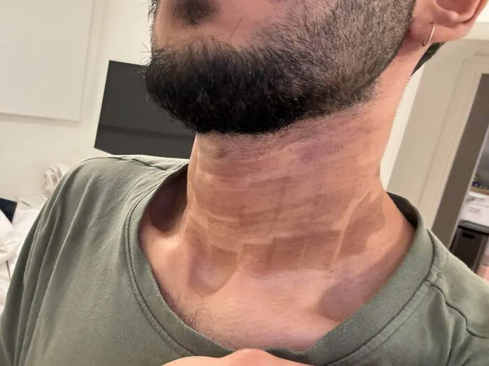 Close-up of a man with patchy, uneven laser hair removal burns on his neck showcasing beauty procedures fails.