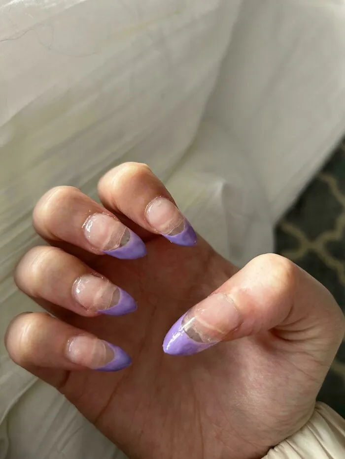 A hand showing badly overgrown purple acrylic nails, highlighting beauty procedures fails