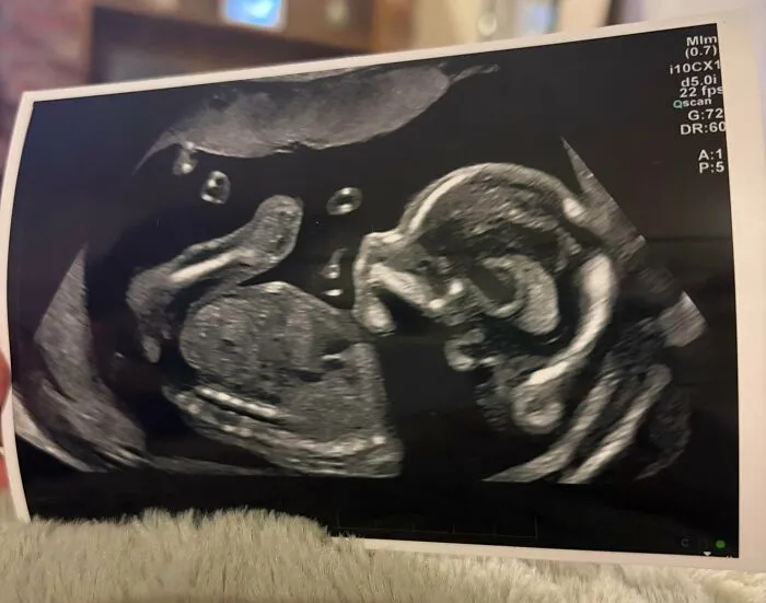 An ultrasound scan image showcasing a growing baby during pregnancy.