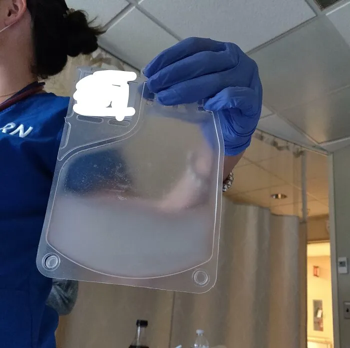 Nurse holding a bag of cloudy plasma, showing interesting and cool photos of medical phenomena.