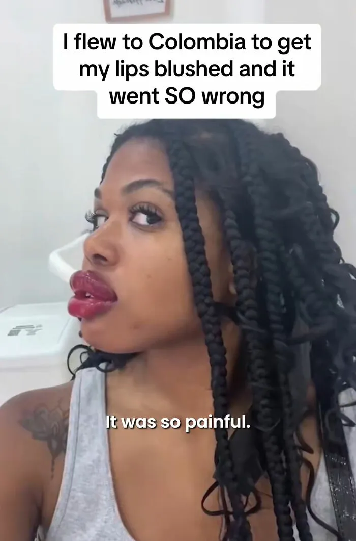 A woman with swollen and uneven red lips after lip blushing, representing beauty procedures fails