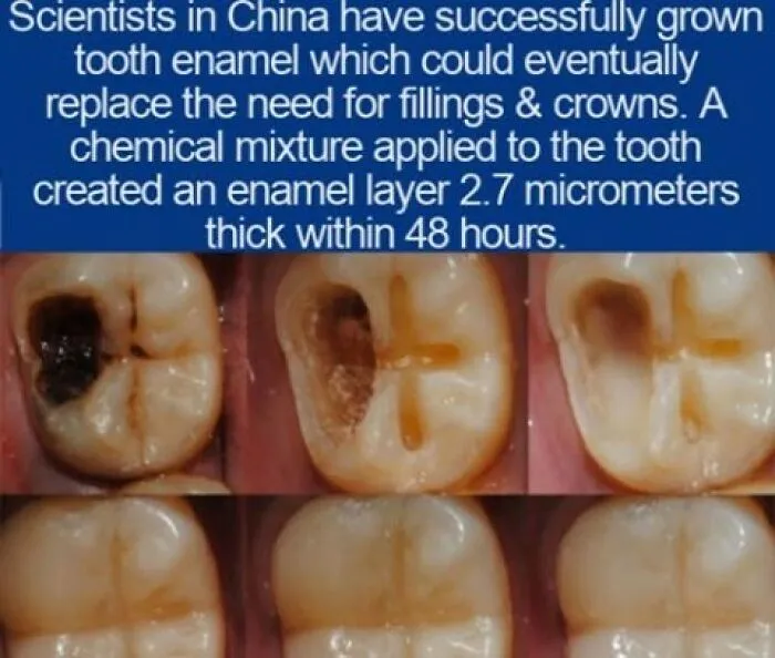 Interesting facts comparison images of grown tooth enamel replacing the need for fillings
