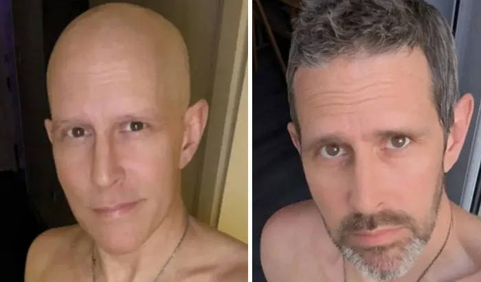During And After Chemo. Sending Hugs Brother