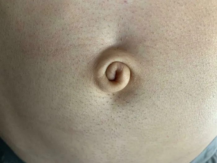 I Was Born With One Of The Rarest Forms Of Belly Buttons In The World