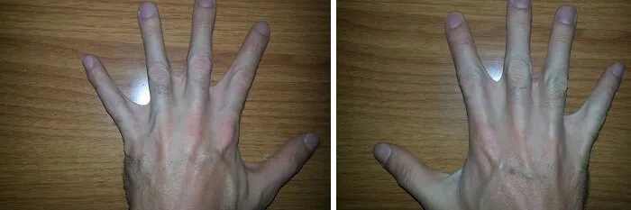 I See Your Single Webbed Finger And Raise You Both Hands