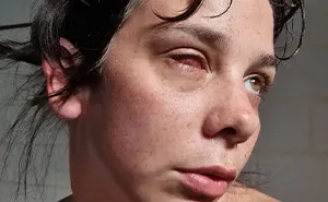 Woman Thinks Her Blurry Vision Is Just A Hangover, Ends Up Losing Her Eye After Doctors Find A Tumor
