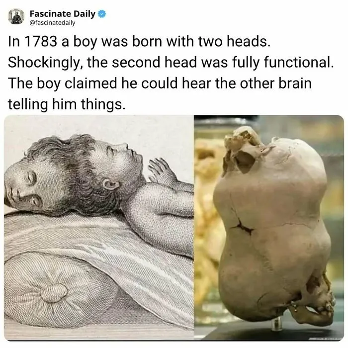 Boy born in 1783 with two functional heads, second brain heard voices
