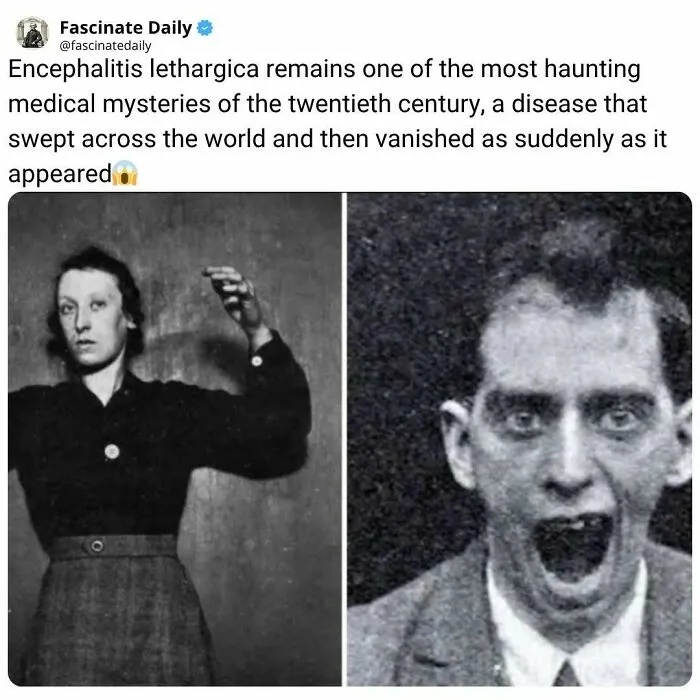 Encephalitis lethargica medical mystery from the twentieth century