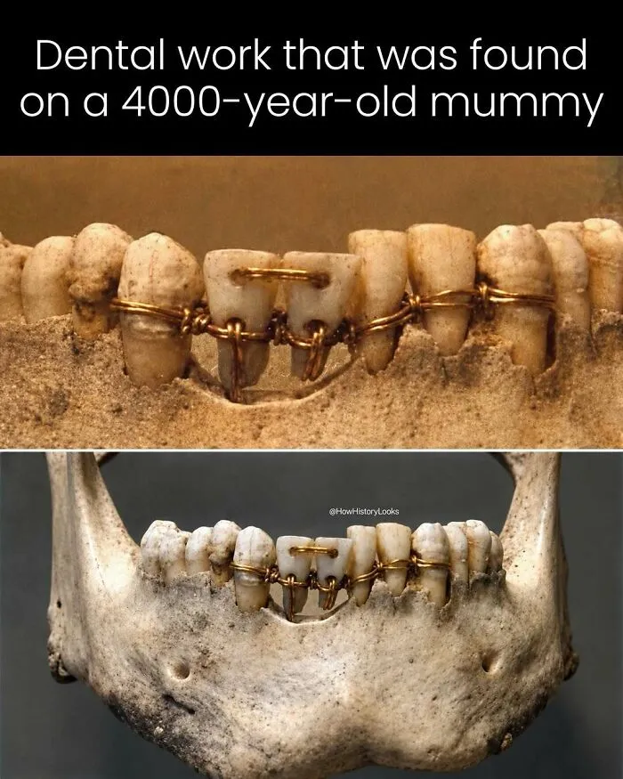 Ancient dental work on a 4000-year-old mummy, showcasing fascinating photos from history.