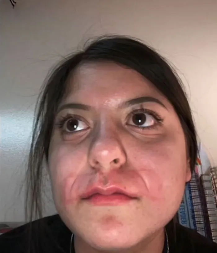 A girl with red irritated skin around her mouth depicting beauty procedures fails