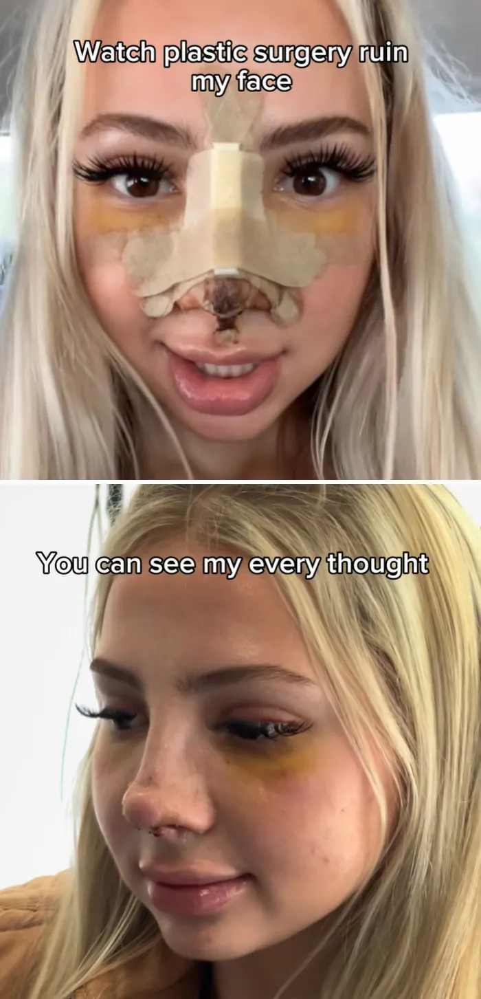 Before and after images of a woman experiencing plastic surgery and beauty procedures fails on her nose