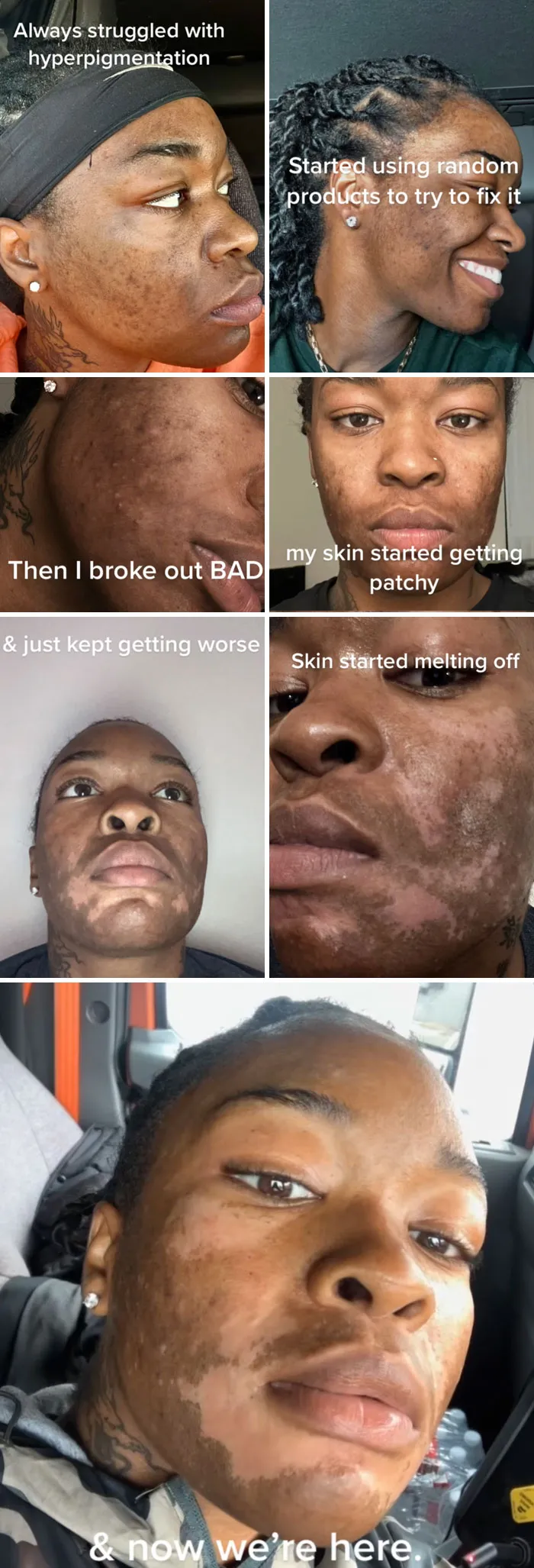 Grid of images showing severe skin damage and hyperpigmentation after beauty procedures fails