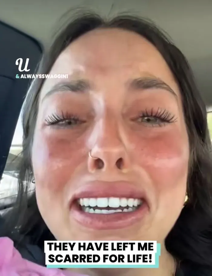 A close-up of a woman crying in her car, showing severe skin redness from beauty procedures fails