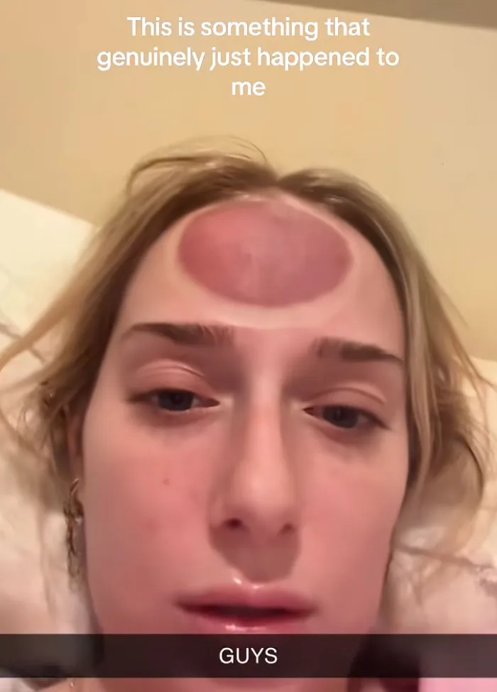 A woman with a round red swelling on her forehead highlighting beauty procedures fails